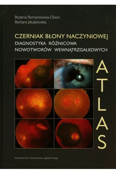 Czerniak b�ony naczyniowej. Diagnostyka r�nicowa - Barbara Jakubowska, Bo�ena Romanowska-Dixon