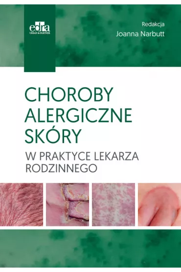 Choroby alergiczne sk�ry w praktyce lekarza rodzinnego - Joanna Narbutt