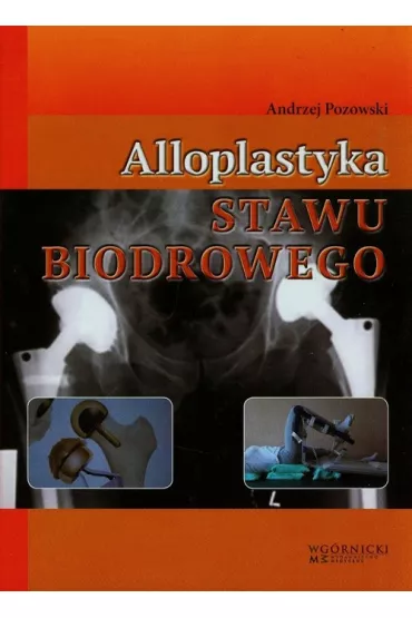 Alloplastyka stawu biodrowego - Andrzej Pozowski