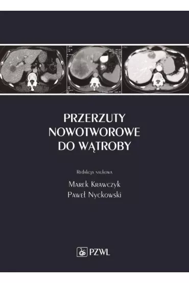 eBook Przerzuty nowotworowe do w�troby mobi epub - Marek Krawczyk, Pawe� Nyckowski