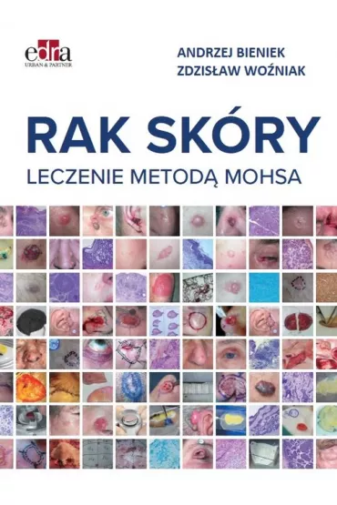 Rak sk�ry. Leczenie metod� Mohsa - Andrzej Bieniek, Zdzis�aw  Wo�niak