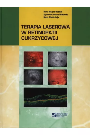 Terapia laserowa w retinopatii cukrzycowej - Marta Misiuk-Hoj�o, Agnieszka Jamrozy-Witkowska, Maria Muzyka-Wo�niak