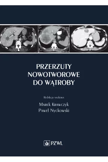Przerzuty nowotworowe do w�troby - Marek Krawczyk, Pawe� Nyckowski